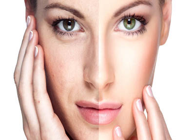Tratamiento Rejuvenecimiento Facial